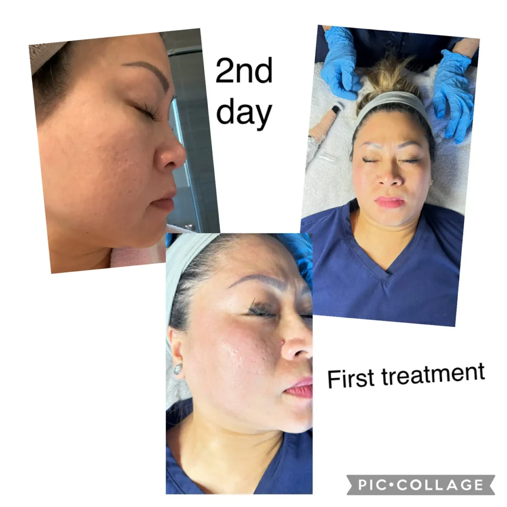 Procell Microchanneling Treatment